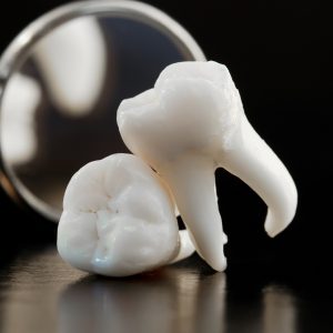 10.4 ผ่าฟันคุด Wisdom Tooth Removal