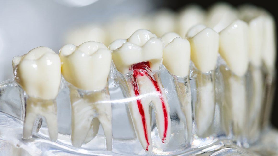 รักษารากฟัน รักษารากฟัน / ตัดปลายรากฟัน