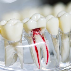 รักษารากฟัน Root canal treatment / cutting off the tip of the tooth root