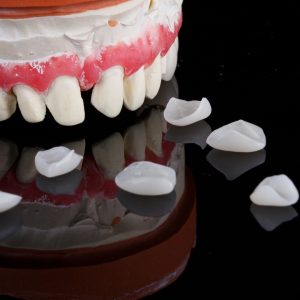 14.7 ครอบฟัน เเละ สะพานฟัน Crowns and Bridges