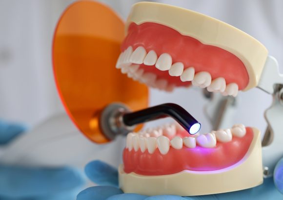 อุดฟันเพื่อปิดช่องว่างของฟัน