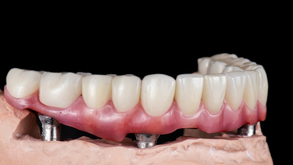 ALL ON What are the benefits of full-mouth dental implants?