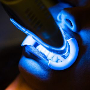 ฟอกสีฟัน คืออะไร