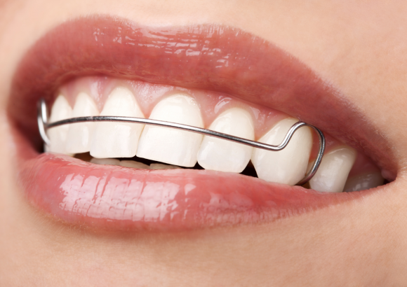 รีเทนเนอร์แบบลวด